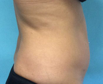 Smartlipo™ Treatment Before & After