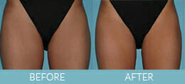 SmartLipo™ Gallery