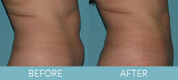 SmartLipo™ Gallery