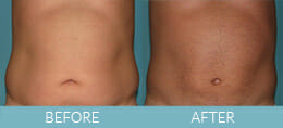 SmartLipo™ Gallery