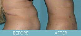 SmartLipo™ Gallery