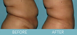 SmartLipo™ Gallery