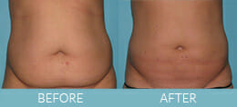 SmartLipo™ Gallery