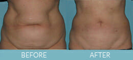 SmartLipo™ Gallery