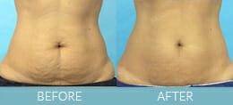 SmartLipo™ Gallery