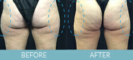 SmartLipo™ Gallery