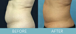 SmartLipo™ Gallery