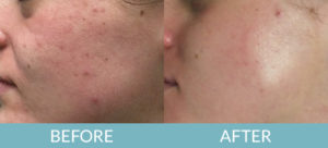 Microdermabrasion & Chemical Peels Gallery