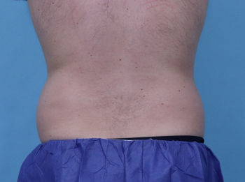 Before CoolSculpting® by Dr. Normand Miller, Salem, NH and Nashua, NH